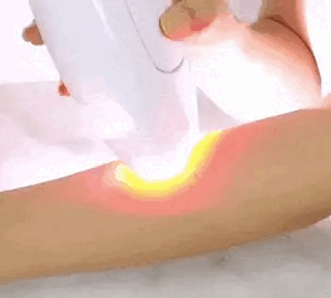 depiladora láser IPL portátil color blanco eliminando vello en piernas